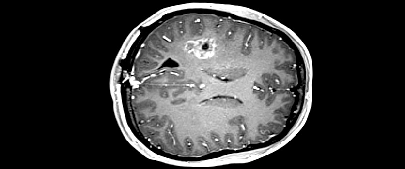 Interventional Neuroradiology Image