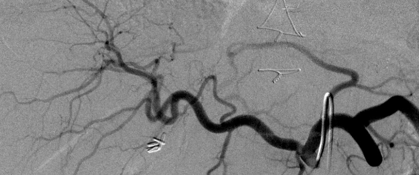 Vascular Interventional Radiology Image